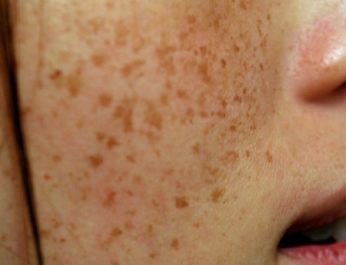 What Causes Pigmentation