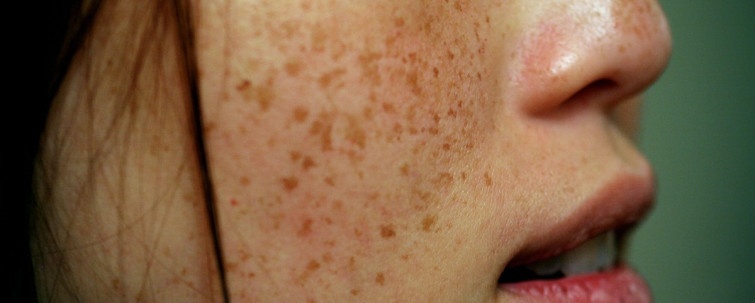 What causes pigmentation