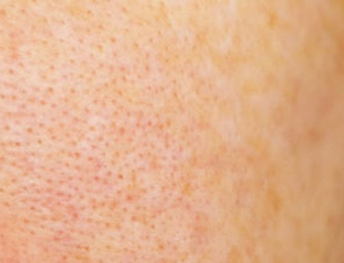 How To Shrink Large Pores
