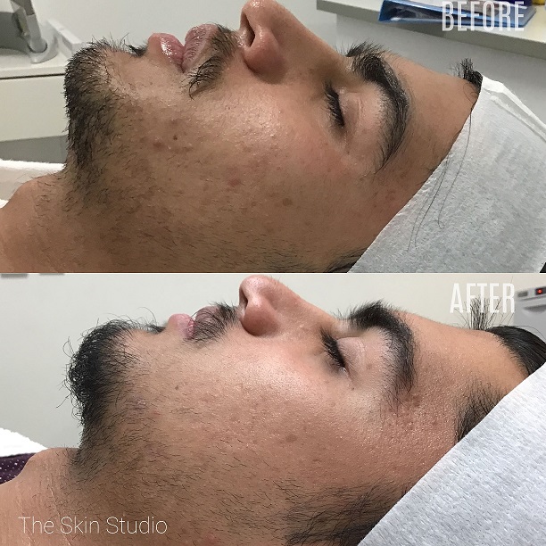 Before and After Chemical Peel Perth