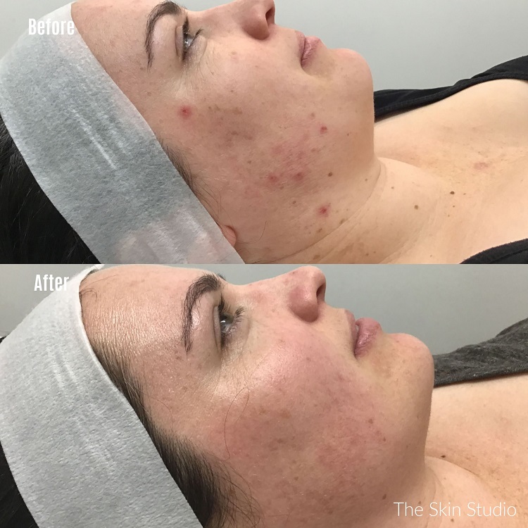 Chemical Peels Perth
