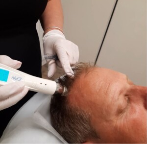 Mesotherapy Hair Loss Treatment