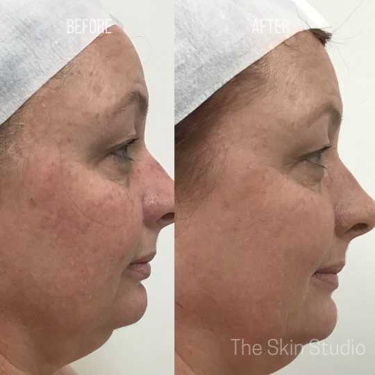 Power Peel Before and After