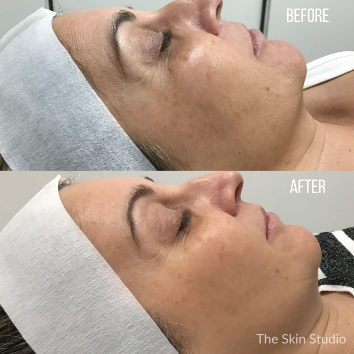 Skin Needling Before and After