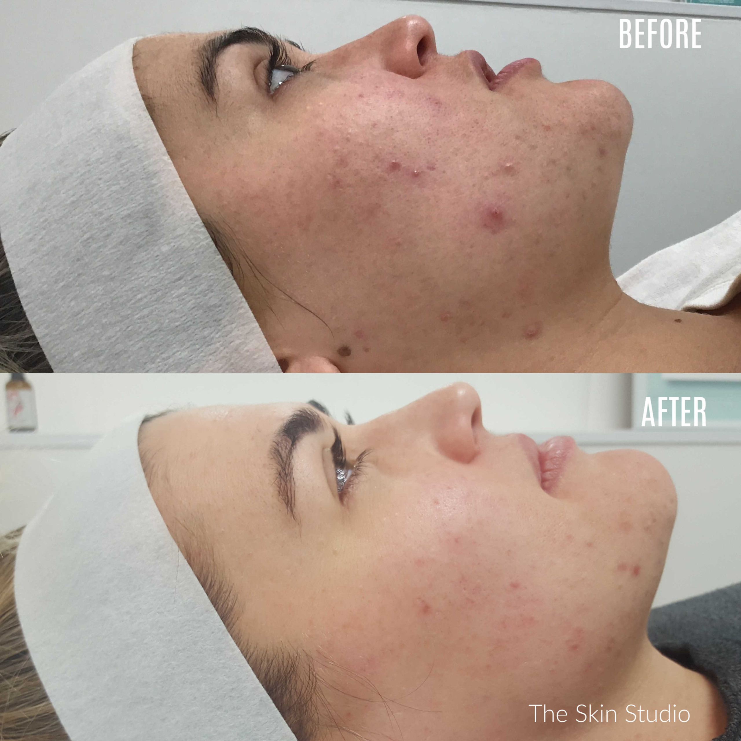 Before and After Chemical Peel Perth