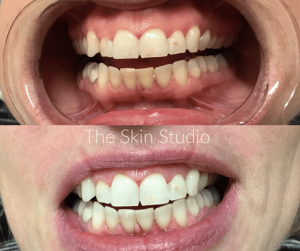 Teeth Whitening Perth