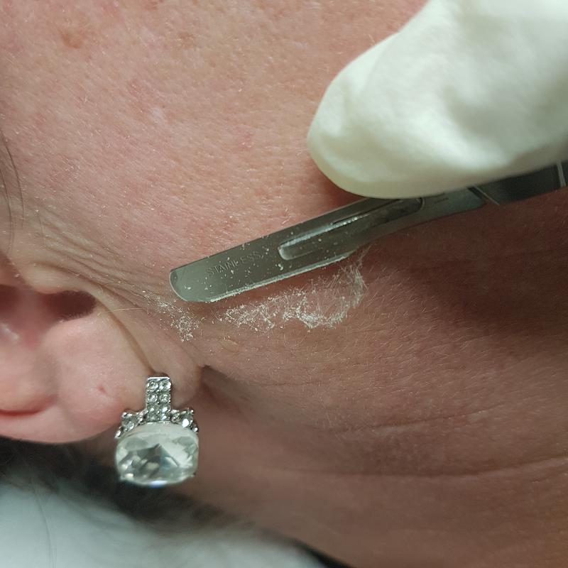 Dermalplaning - Epidermal Levelling - Perth