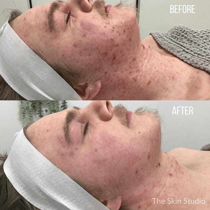 Before and After LED Light Therapy Eczema Treatment 