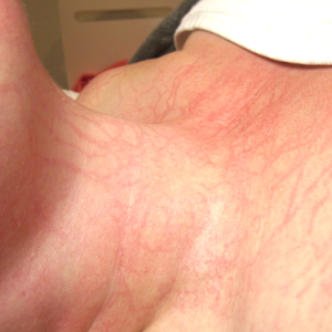Dermafix Enzyme Mask