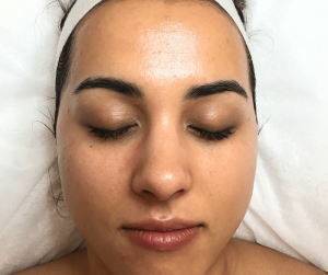 Alkaline Peel