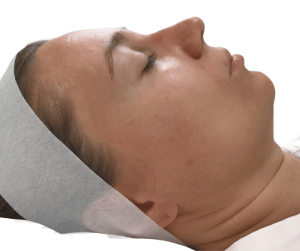 Problem Skin Peel for acne
