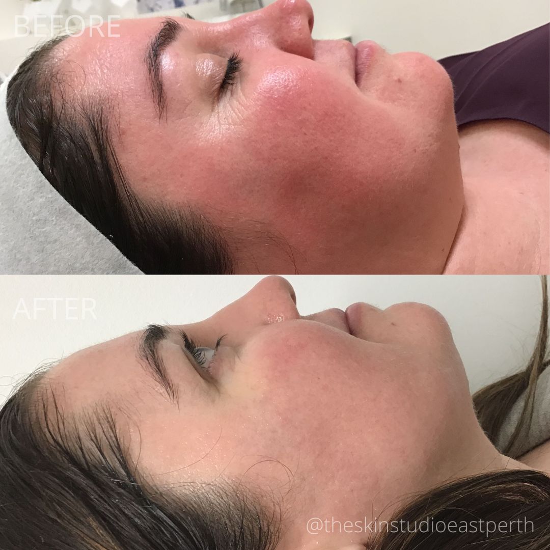rosacea redness laser treatment IPL and Laser Pigmentation Removal Treatment Perth Cosmetic Clinic