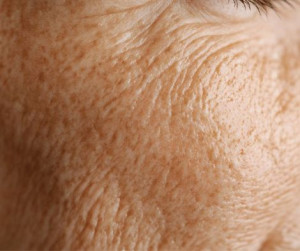 Antiwrinkle Treatment Perth Anti-wrinkle Treatment Perth