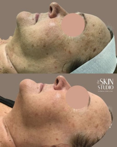 BBL Age Spot Removal Perth Before and After BBL Age Spot Removal Perth Before and After