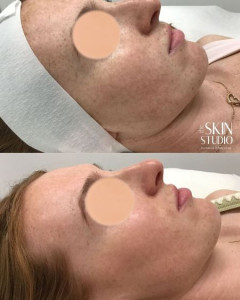 BBL Pigmentation Removal Perth Before and After BBL Pigmentation Removal Perth Before and After