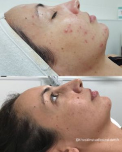 Before and After Acne Treatment Photos Perth Acne Treatments