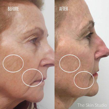 Best Non-Surgical Facelift Best Non Surgical Facelift