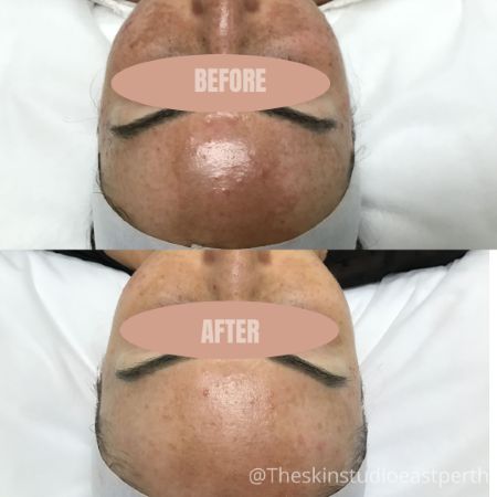 Best Treatment for Melasma on Face Perth Best Treatment for Melasma on Face in Perth
