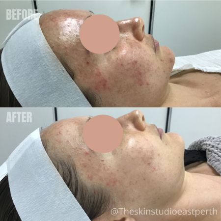 Best Treatment for Melasma Best Treatment for Melasma and Hormonal Pigmentation