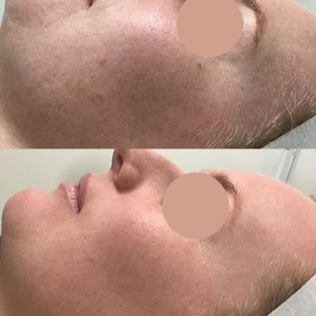 Dry Skin Facial Perth Dry Skin Facial treatment in Perth