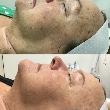 Dry vs Dehydrated Skin Dry and Dehydrated Skin Treatment Perth