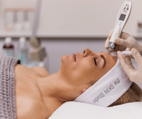 Hormonal Pigmentation Treatment Microneedling