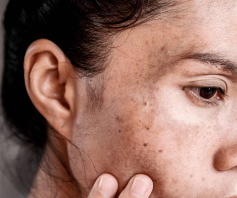 Melasma Treatments Melasma Treatments Perth Skin Clinic
