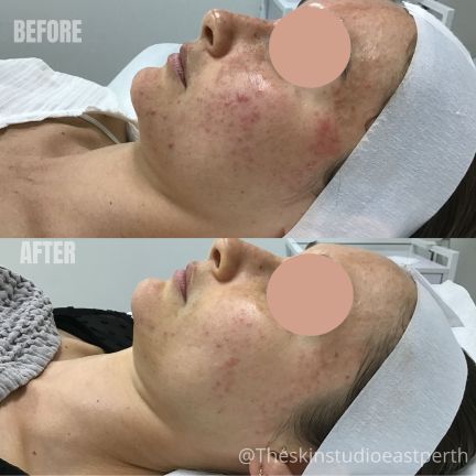 Melasma vs Hyperpigmentation Melasma vs Hyperpigmentation. What is the difference?
