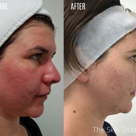 Menopausal acne rosacea Menopausal Acne Rosacea Before and After Picture Perth