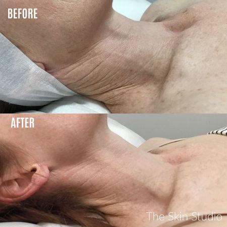 Neckline wrinkles Neck Line Wrinkle Treatment