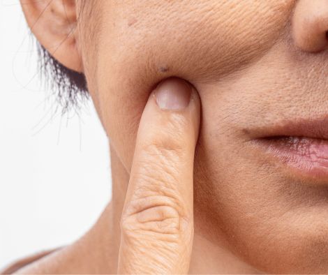 Skin Problems in Menopause Skin Problems in Perimenopause and Menopause