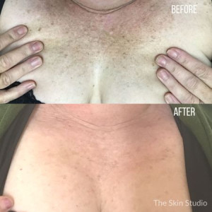 Solar Lentigo Hyperpigmentation Treatment IPL and Laser Pigmentation Removal Treatment Perth Cosmetic Clinic