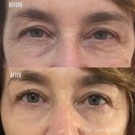 Under Eye Wrinkles Treatment Under eye wrinkle treatment
